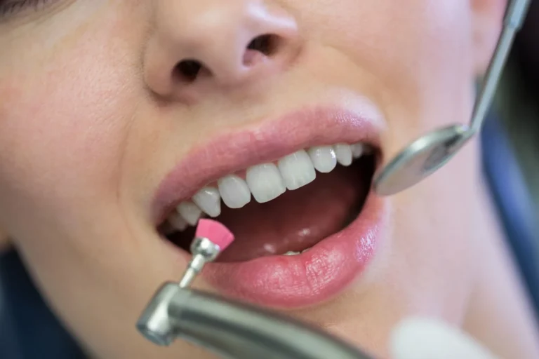 Is Fluoride Safe in Dental Treatments?